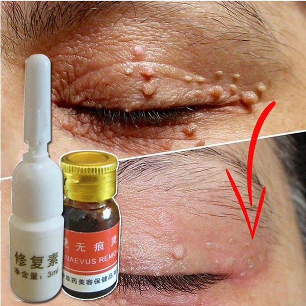 skin tag removal treatment cream face care mole