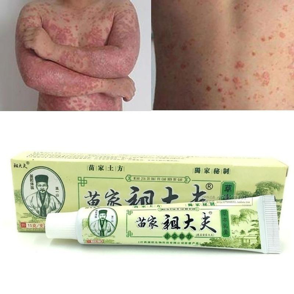 Best Design 1Pc Chinese Herbal Psoriasis Dermatitis Eczema Pruritus ...