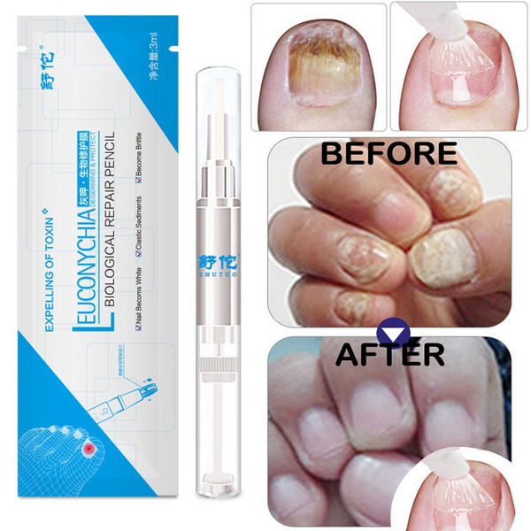 1pc 3ml Fungal Nail Treatment Pen Onychomycosis Paronychia Anti Fungal Nail Infection Chinese Herbal Toe Nail Fungus Treatment Wish