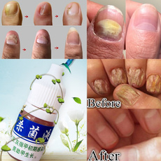 10ml Health Skin Care Nail Repair Treatment Liquid Cleanser Onychomycosis Remover Serum Beauty Disinfect Water