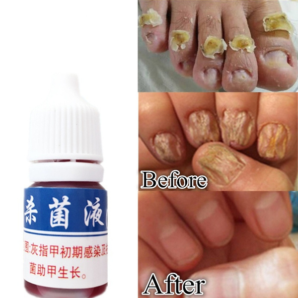 Buy Wholesale China Wholesale Fungal Nail Repair Remove Nail Foot Nail  Fungus Treatment & Fungus Nail Repair at USD 0.98 | Global Sources