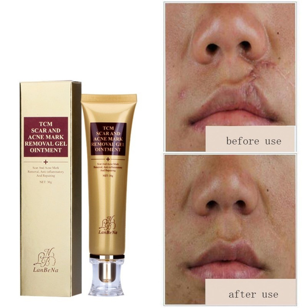 tcm scar and acne mark removal gel ointment price