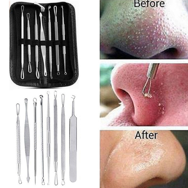 5pc Blackhead Whitehead Pimple Spot Comedone Acne Extractor Remover Popper Tool Kit Geek 4965