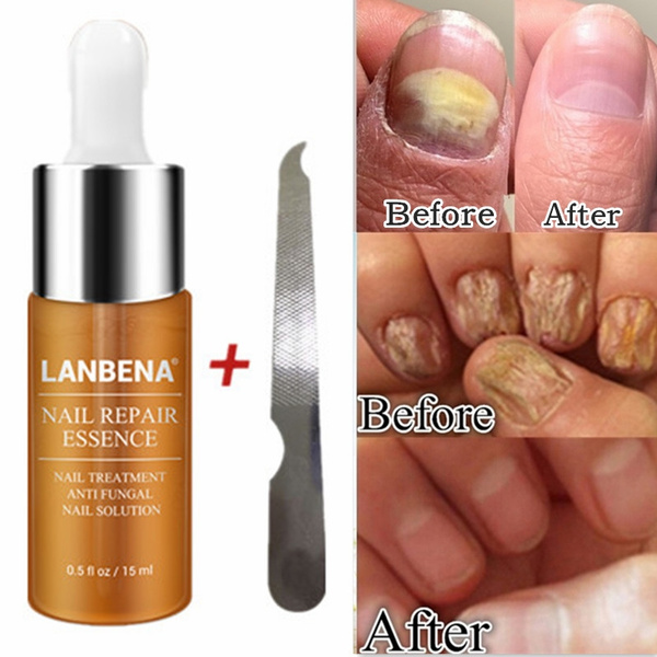 lanbena nail repair