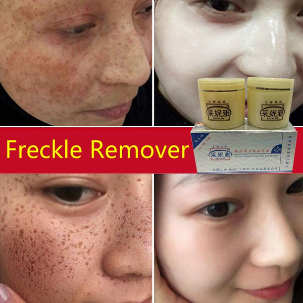 Skin Lightening Cream Freckle Cream Freckle Fade Removal Cream For Face Brightening Dark Spot Skin Pigmentation Age Spots Day Night Cream Wish