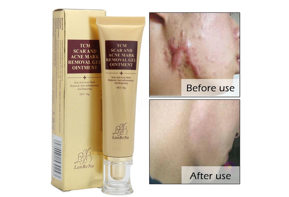 tcm scar and acne