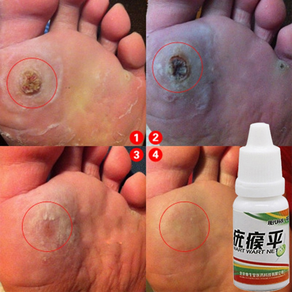 Warts skin body, Plantar Wart Shaving Procedure cell papilloma removal