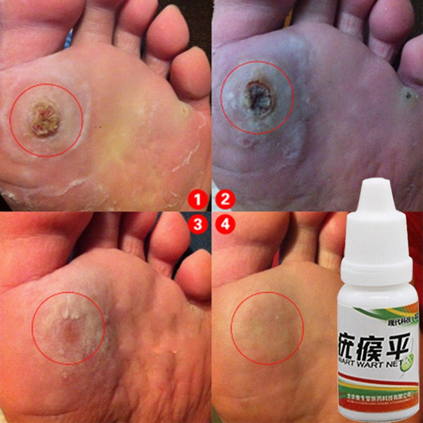 wart on foot cream