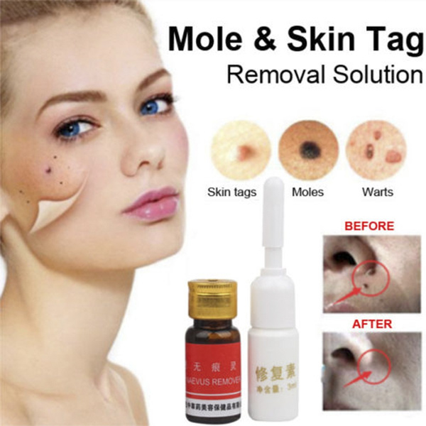 skin tag and mole removal skin tag mole remover moles and skin tags