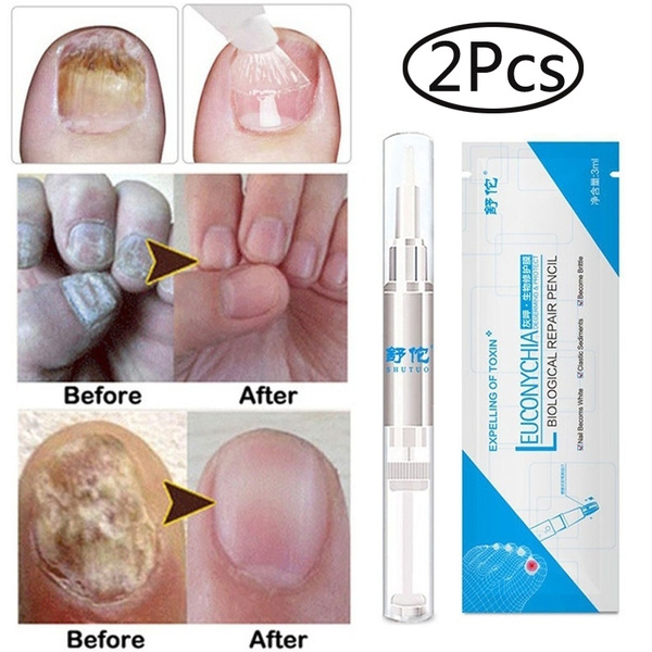 Fungal Nail Treatment Feet Care Essence Nail Foot Whitening Toe Finger