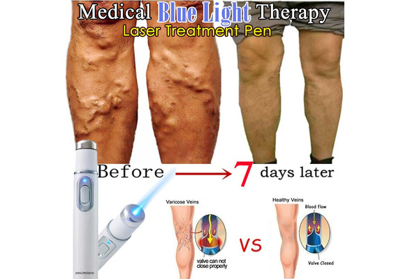 blue light therapy for varicose veins