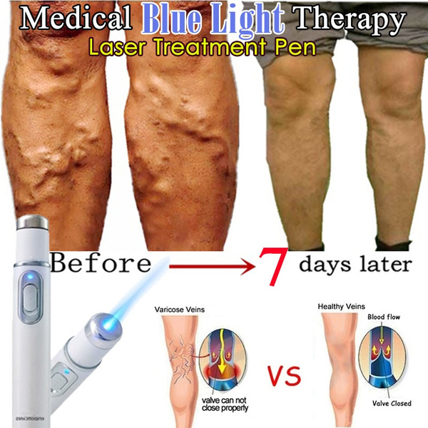 varicose veins treatment blue light therapy