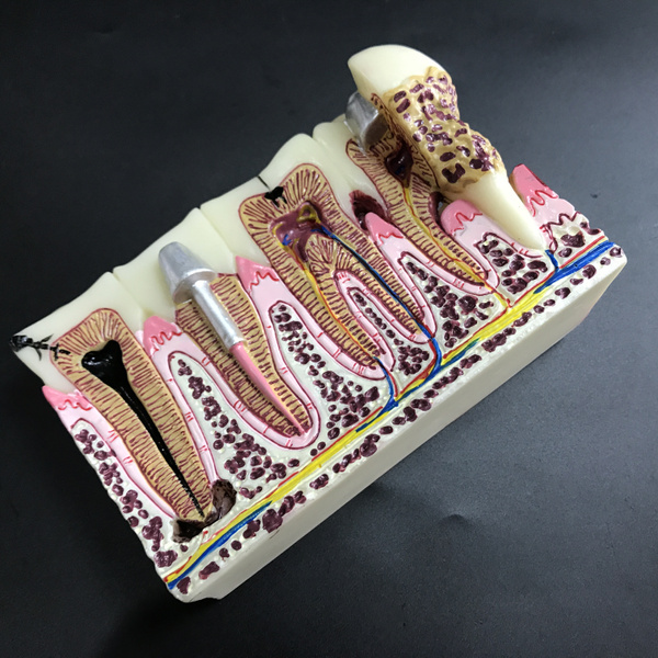 Dental Anatomy of dental caries plastic teeth model demonstration ...