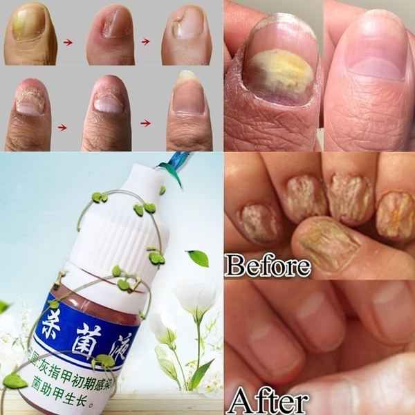 10ml Powerful Fungus Nail Treatment Cream Onychomycosis Paronychia Anti Fungal Nail Infection Fights Bacteria And Fungus Wish