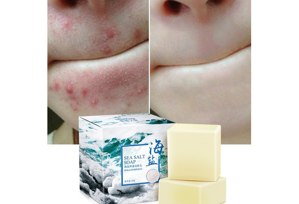 sea salt soap for acne
