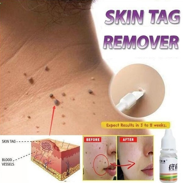 Hot Sale Skin Tag Remover Warts Treatment Foot Corn