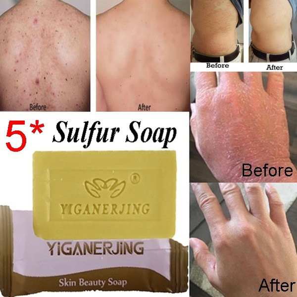 Munching Accommodatie Terughoudendheid 5 stks / set Mini Zwavel Zeep Olie-controle Acne Behandeling Comedondrukker Zeep Whitening Cleanser Chinese Traditionele Huidverzorging | Wish Munching Accommodatie Terughoudendheid 5 stks / set Mini Zwavel Zeep Olie-controle Acne Behandeling Comedondrukker Zeep Whitening Cleanser Chinese Traditionele Huidverzorging | Wish