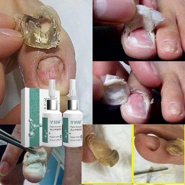 Natural Nail Fungus Treatment & Remedy for Your Symptoms