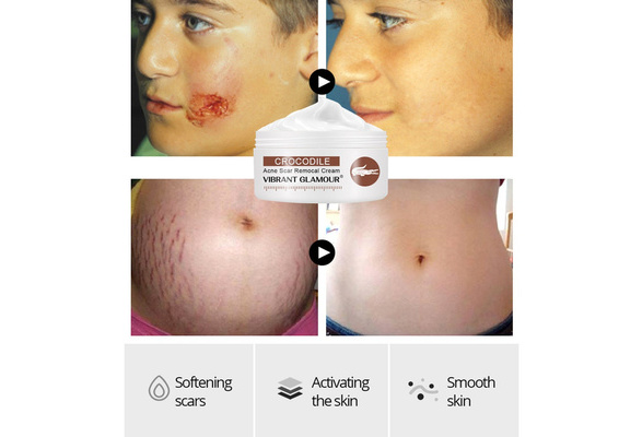 crocodile cream for stretch marks