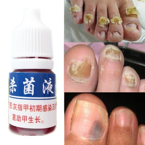 does nail polish work on ringworm