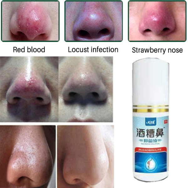 rosacea nose cream