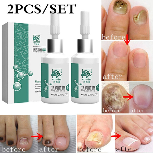 Natural Effective Nail Fungal Feet Repair Cream Foot Toe Nail Fungus  Removal Gel Anti Infection Paronychia Onychomyco Ointment - China Nail  Fungus Pen, Antifungal Nail Treatment | Made-in-China.com