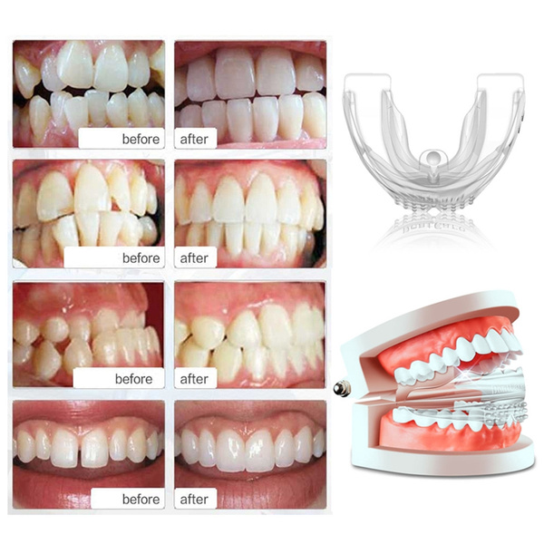 silicone teeth straightener