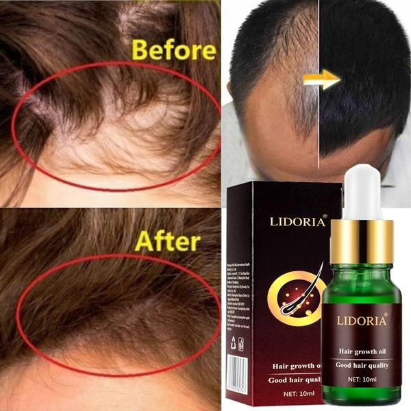 10ml 100% Original Hair Loss Products Natural With No Side Effects Grow Hair  Faster Regrowth Hair Growth Products | Wish