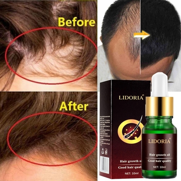 10ml 100% Original Hair Loss Products Natural With No Side Effects Grow Hair Faster Regrowth Hair Growth Products | Wish 10ml 100% Original Hair Loss Products Natural With No Side Effects Grow Hair Faster Regrowth Hair Growth Products | Wish