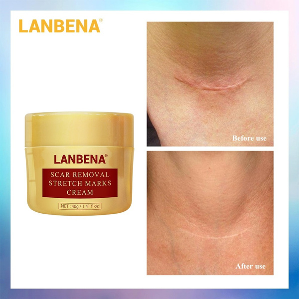 Lanbena scar deals removal