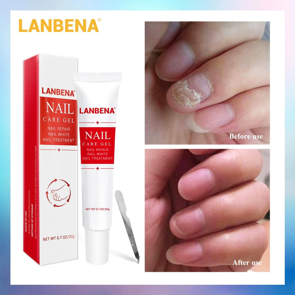 LANBENA Nail Care Gel Fungal Nail Treatment Remove Onychomycosis Nail ...