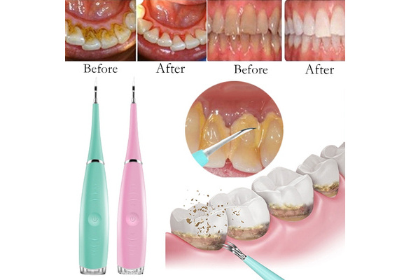 Portable Electric Sonic Dental Scaler Tooth Calculus Remover Tooth Stains Tartar Tool Dentist Whiten Teeth Health Hygiene White Wish