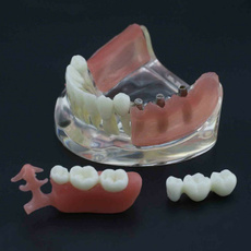 dentalmodel, implantmodel, dentalimplantmodel, removablebridge
