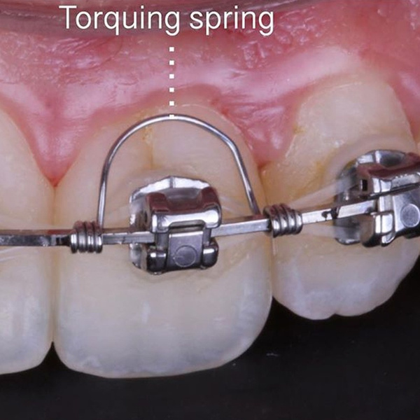 50Pcs Dental Orthodontic Torquing spring Wish