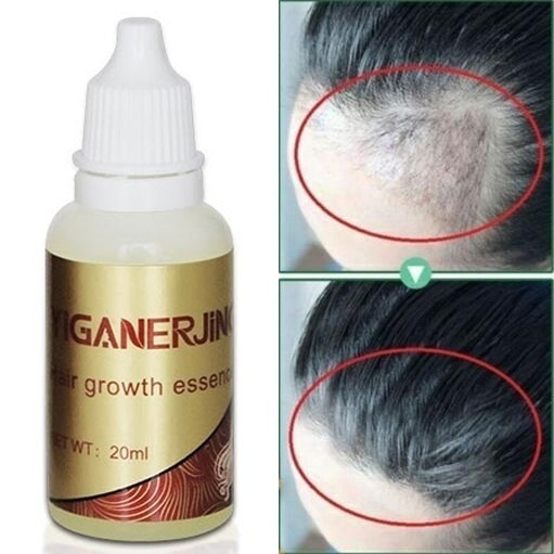 Newly 20ml Hair Growth Essence Hair Loss Liquid 20ml Dense Hair Fast ...