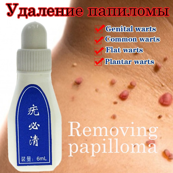papilloma skin removal