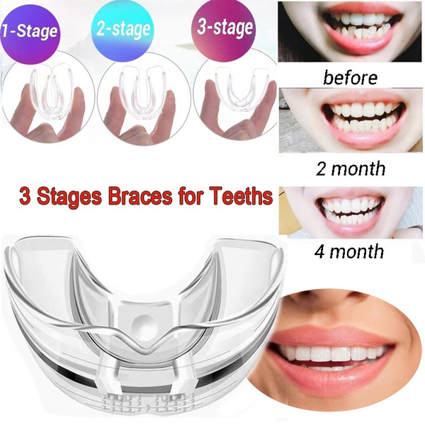 teeth alignment for adults