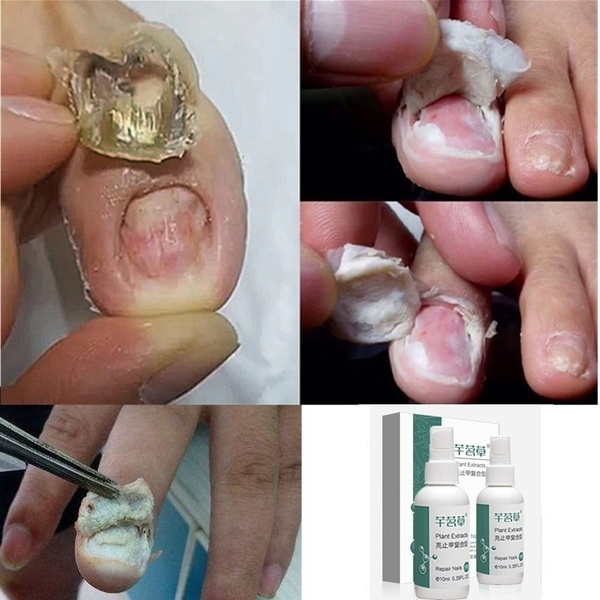 nail fungus treatment)