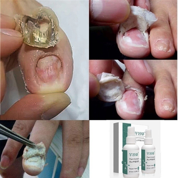 Lamisil cream nail fungus treatment