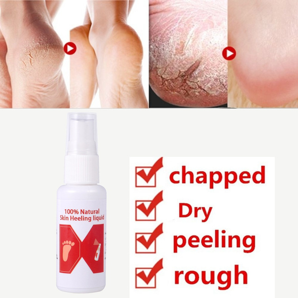 Allergy Foot Itching Cure Anti-foot Cracking Peeling Rough Foot Odor ...