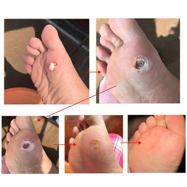 Wart foot sole - Spray antimătreață - Scholl Verruca and Warts Removing Spray Wart foot remove