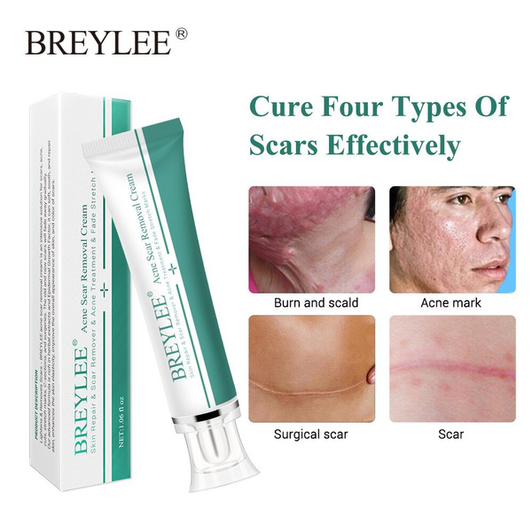 Face Skin Care Removal Cream Acne Spots Scar Stretch Marks Treatment 15 B2♚