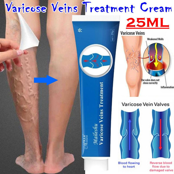 does varicose vein cream work