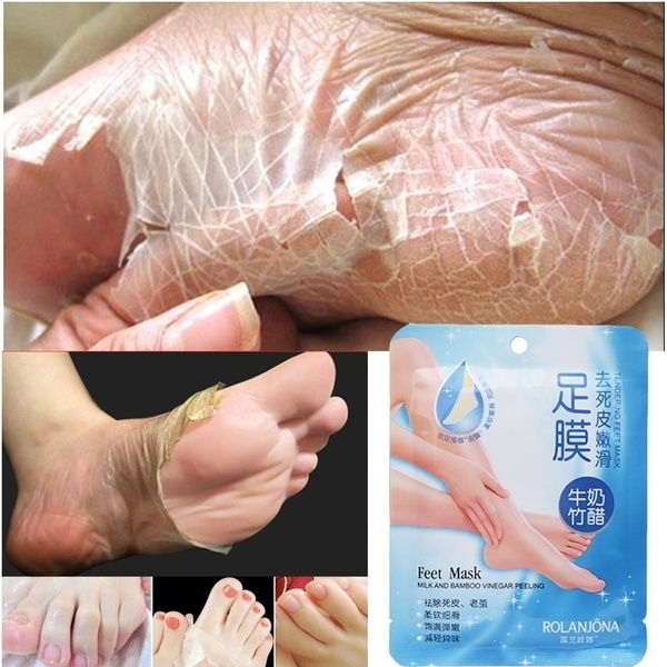 vinegar to remove dead skin on feet