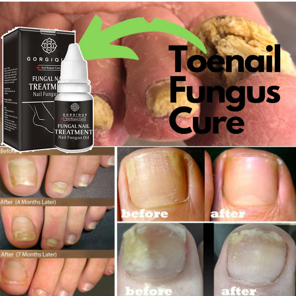 nail fungus készülék knight