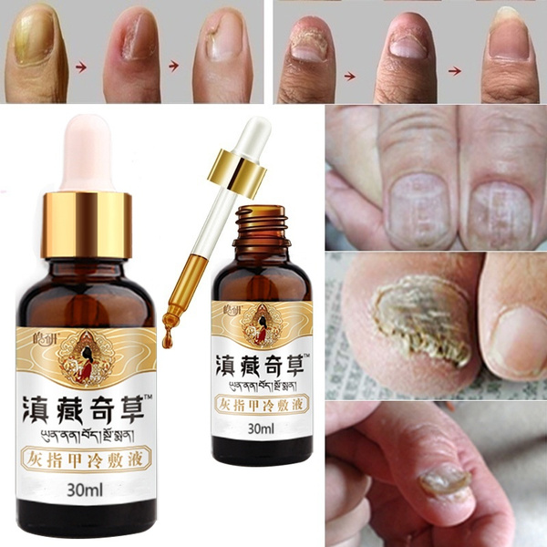 NEW 2020 antifungal maximum strength nail Repair Essence ...