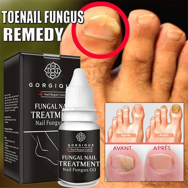 Get Rid of That Toenail Fungus Before Summer: California Foot and Ankle  Clinic: Podiatrists