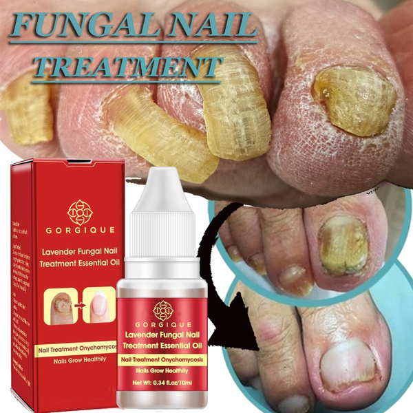foot nail gomba homeopátiás kezelés)