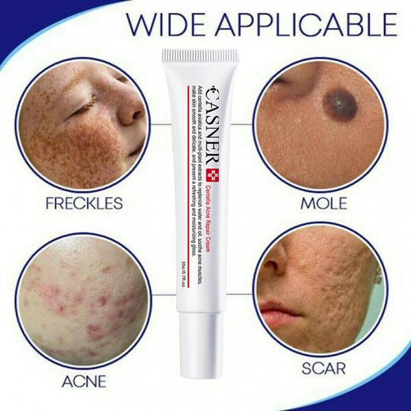 pimple marks reducing cream