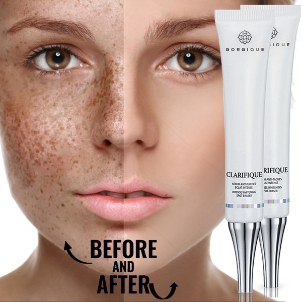 Strong Whitening Cream Freckle Cream Remove Melasma Acne Dark Pigment ...